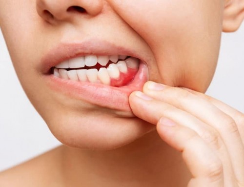 Periodontal Gum Disease in Women