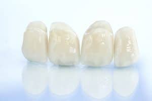 Teeth Crowns - Dental Services