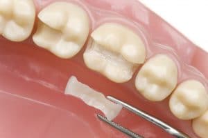 Dental Inlays and Onlays