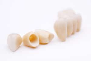 Tooth restorations that can be used in dental bridge